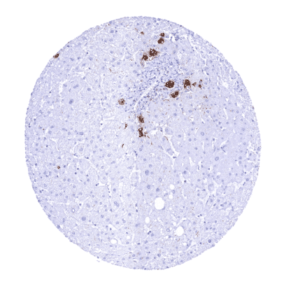 [sk1283] Carbohydrate antigen 19-9 / CA 19-9 (HMV333)