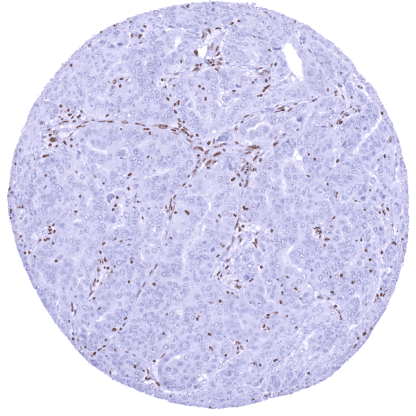 [sk1818] SMARCA2 (HMV337)